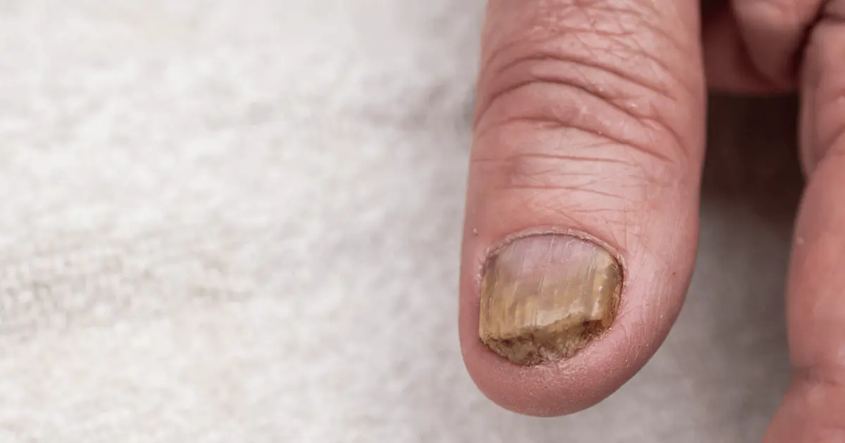 Fungal Infection On Finger Joints